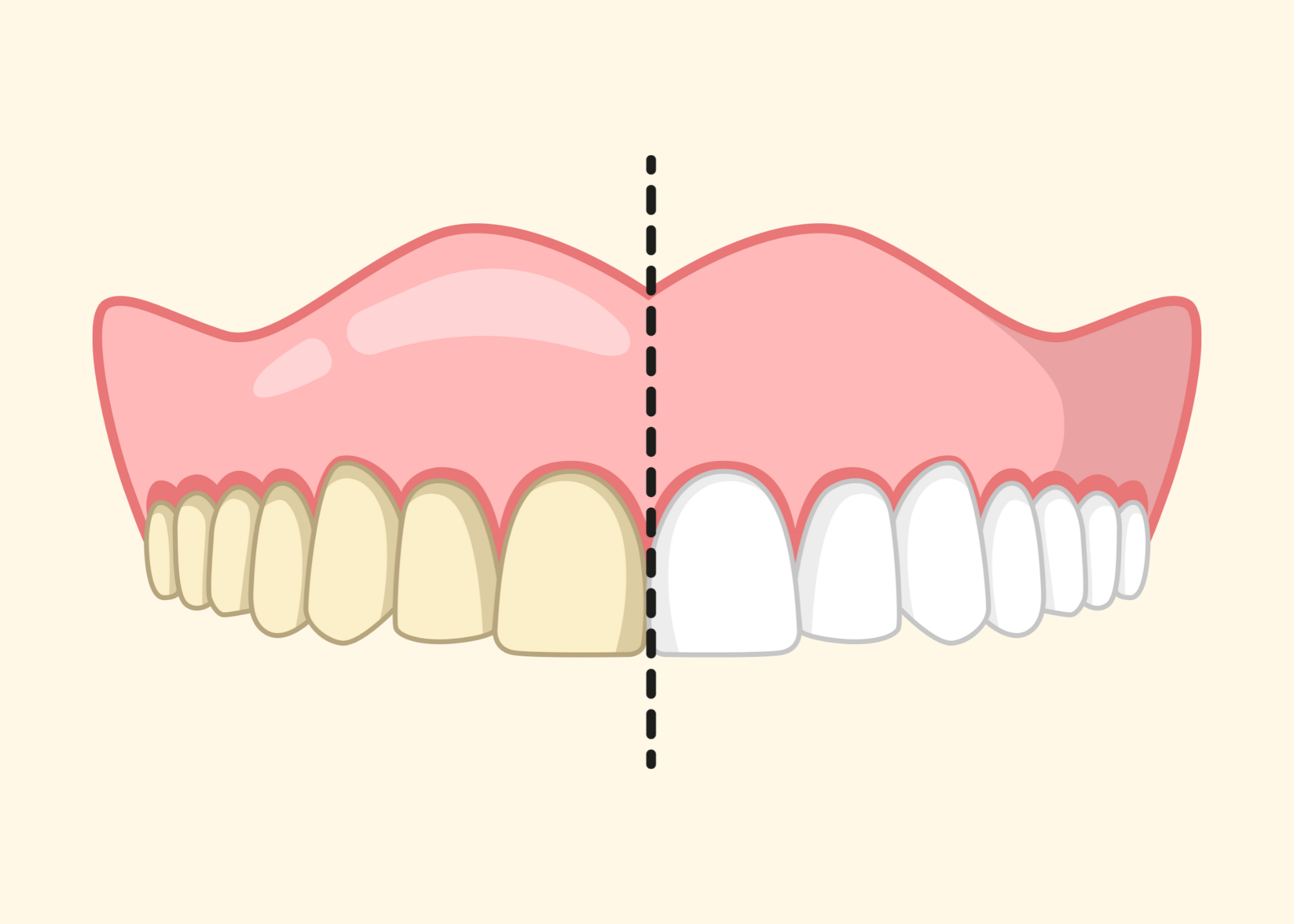 Comparison of yellowed, stained teeth versus bright white teeth.