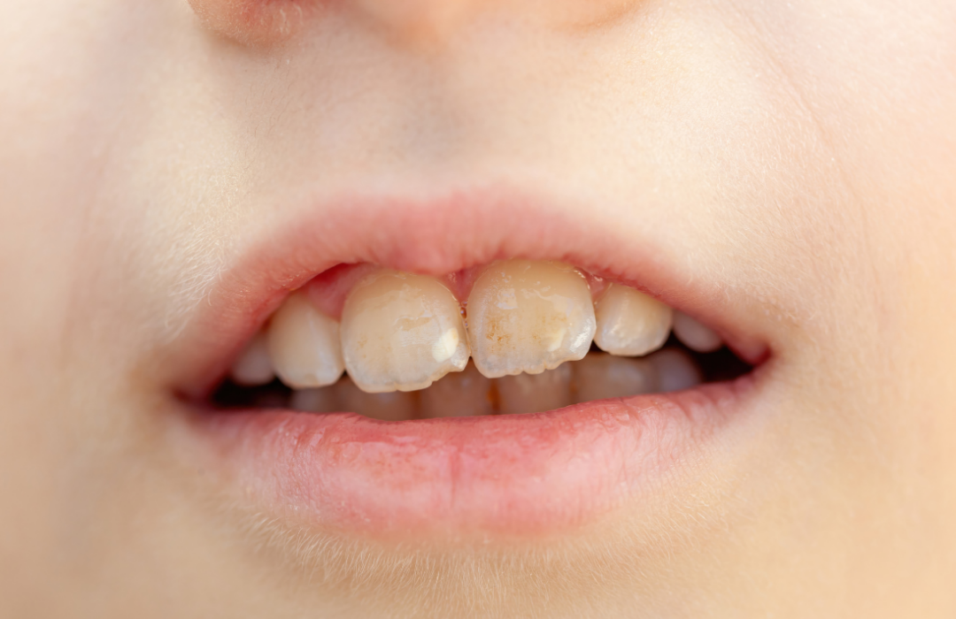 A close up of a person with white spots and streaks on their teeth from dental fluorosis