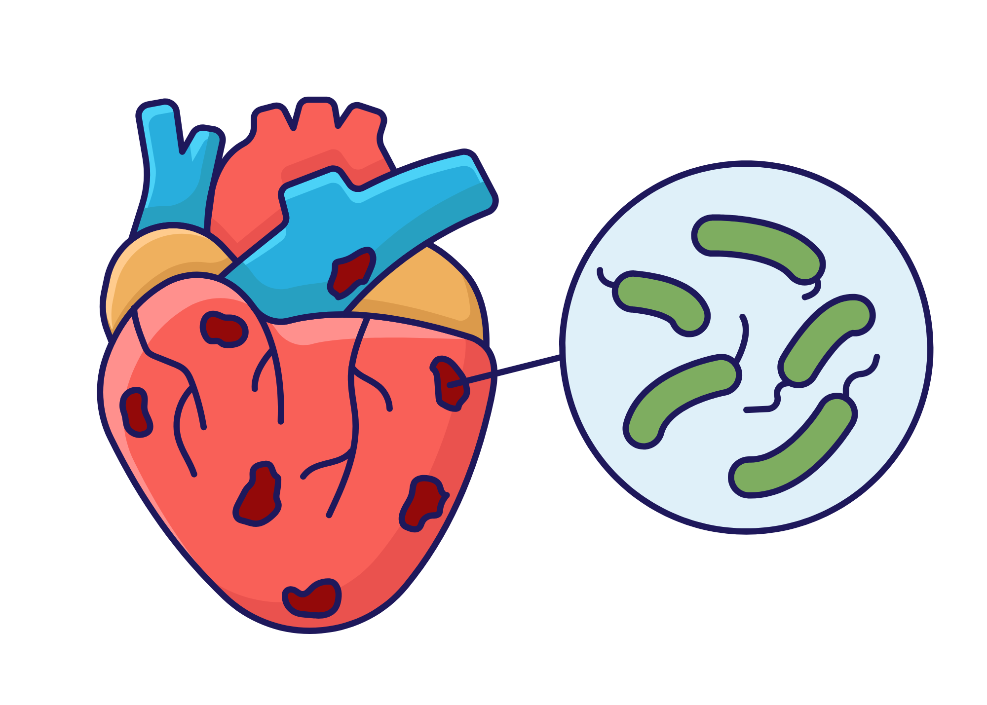 Heart connected to bacteria, representing endocarditis or infection affecting the heart